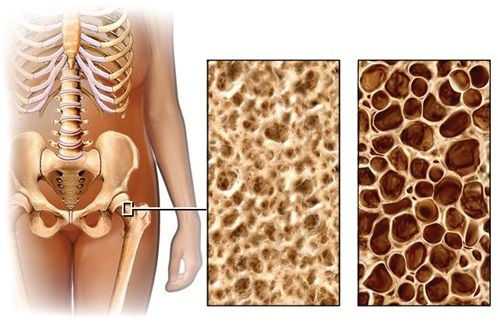 Здровья остеопороз занимает 4 место среди неинфекционных заболеваний