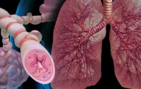 Как контролировать бронхиальную астму