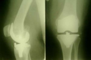 До и после установки эндопротеза коленного сустава